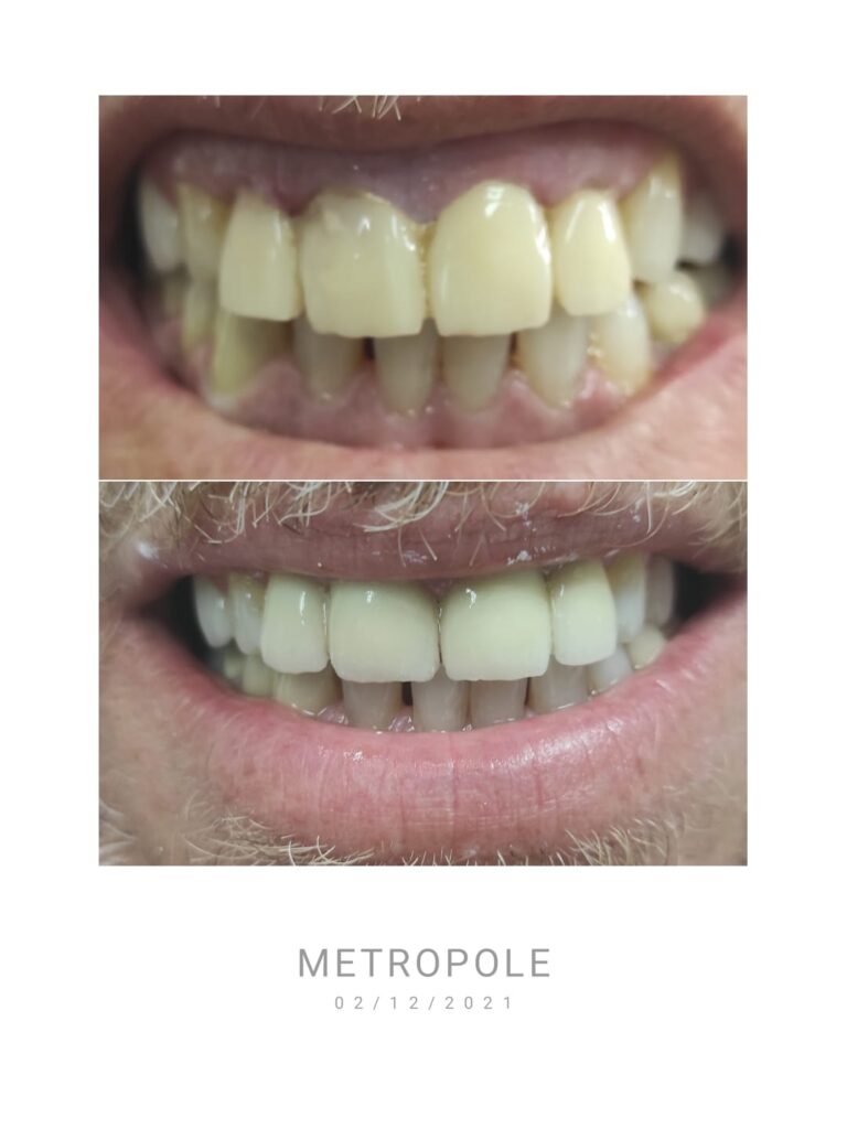 לפני ואחרי כתרי זריקוניה לשיניים קדמיות