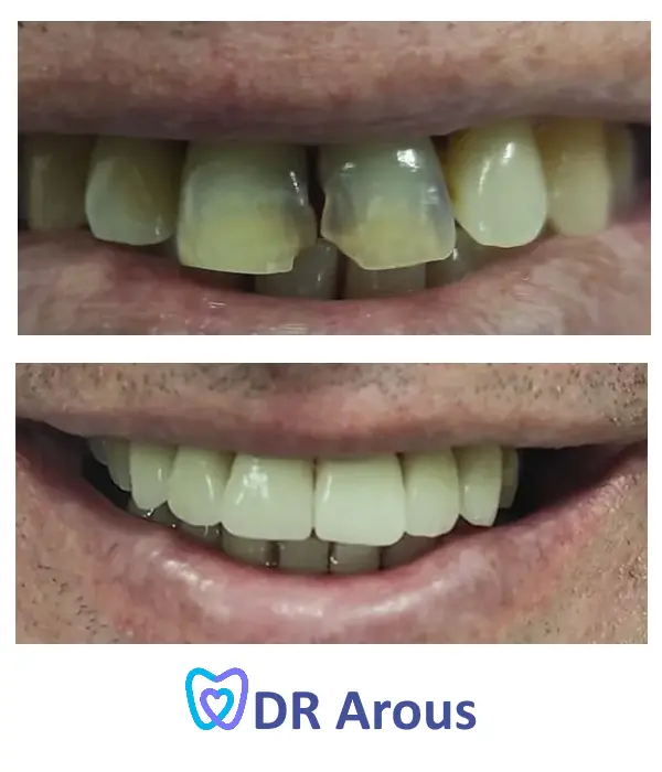 ציפויי ל- 6 השיניים הקדמיות - לפני ואחרי