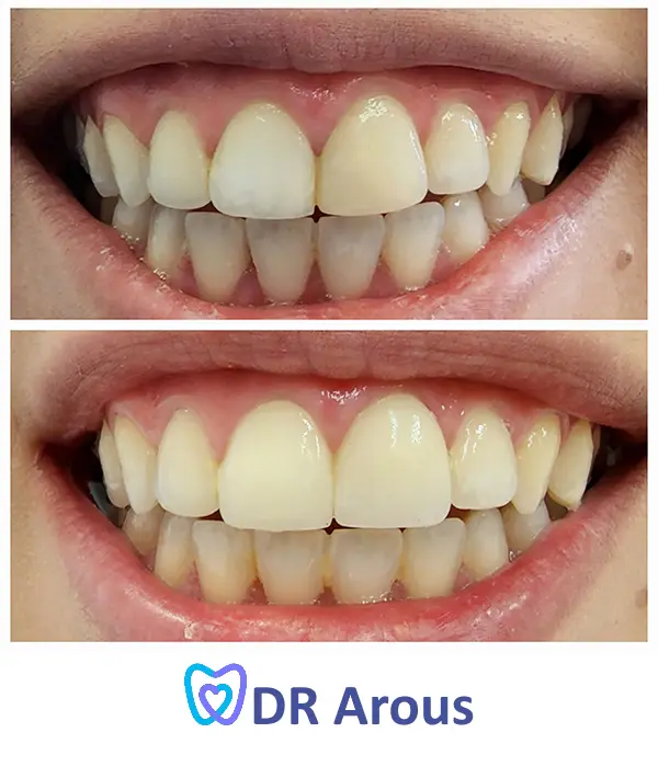 ציפויים לשיניים 11-21 לפני ואחרי